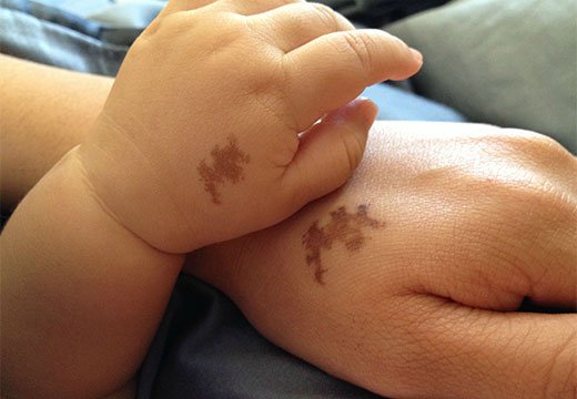 пигментные пятна на руках у ребенка
