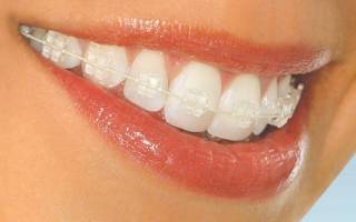 Как ставят брекеты на зубы что ожидает пациента в кресле ортодонта?
