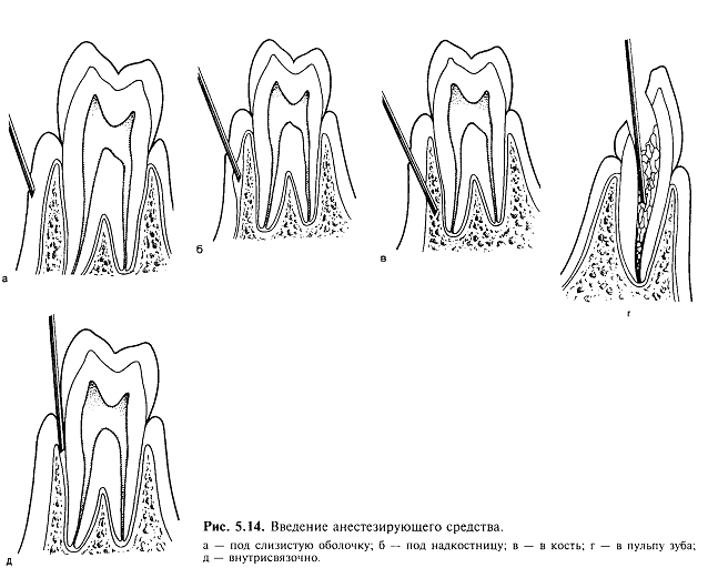 Схема видов анестезии в стоматологии