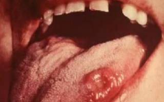 Третья стадия сифилиса во рту
