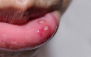 Первая стадия сифилиса во рту