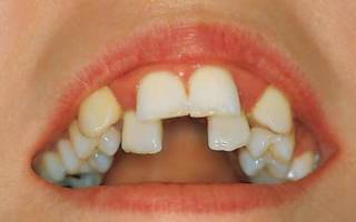 Сильное искривление зубов