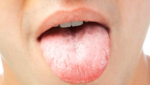 симптомы кандидоза слизистой рта