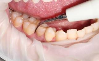 Ультразвуковая чистка зубов от зубного камня