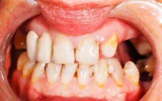 Разрушающиеся зубы