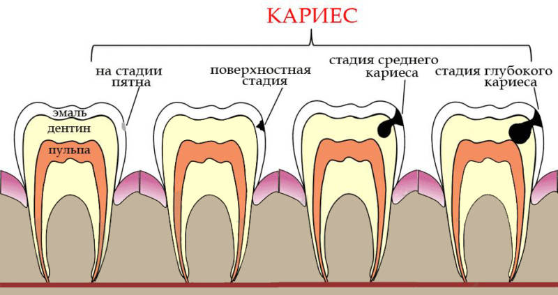 Стадии развития кариеса - картинки