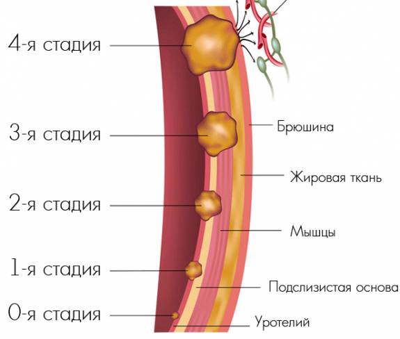 Рак мочевого пузыря 1 стадии