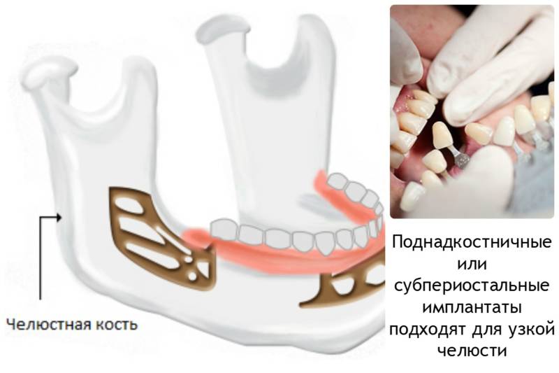 Фото импланты 4 размера