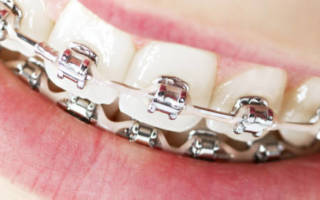 Как ставят брекеты на зубы что ожидает пациента в кресле ортодонта?