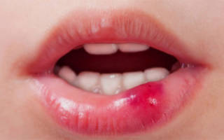 Травма губы