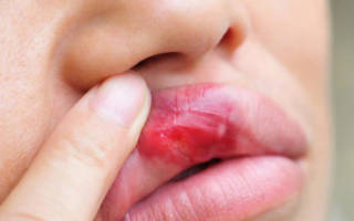 Травма слизистой оболочки губы