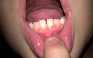 Травма зуба