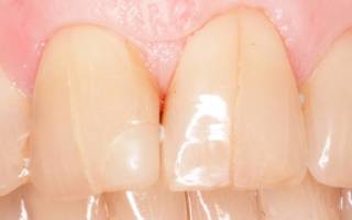Вертикальные трещины на зубах