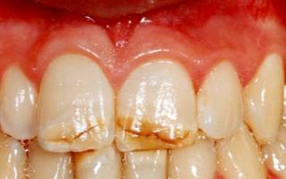 Горизонтальные трещины на зубах