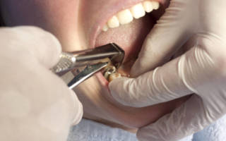 Удаляют зуб