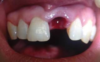 Отсутствие сгустка в лунке зуба