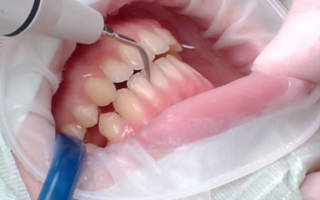 Ультразвуковая чистка от зубного камня