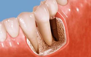 Установка импланта зуба