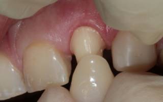 Болит зуб под коронкой