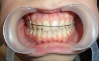 Процесс установки ретейнеров на зубы