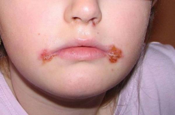 Причины и лечение герпеса во рту у ребенка