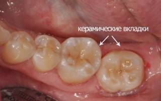 Керамические вкладки в зубах