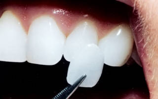 Лучшие способы восстановления зубной эмали в стоматологии и домашних условиях