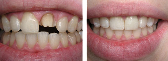 Восстановление разрушенного зуба