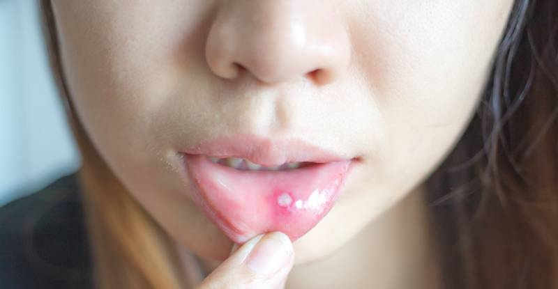 Стоматит на внутренней стороне губы