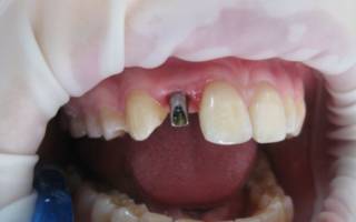 Вживление имплантов зубов
