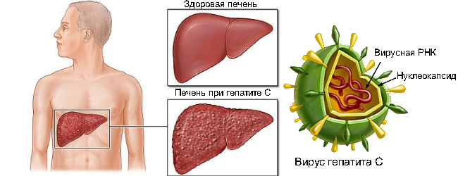 Признаки гепатита