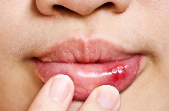 белая болячка на нижней губе