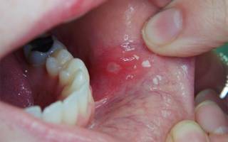 Диагностика, формы и лечение рака слизистой оболочки полости рта