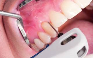 Черный налет на зубах: причины, профилактика и методы избавления