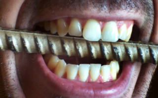 Избыток железа для зубов
