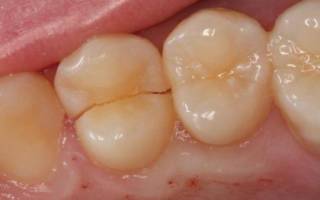 Трещина на жевательном зубе