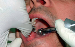 Укол анестезии перед удалением зуба мудрости