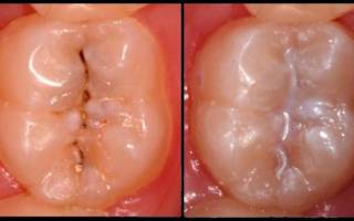 Загерметизированный зуб до и после