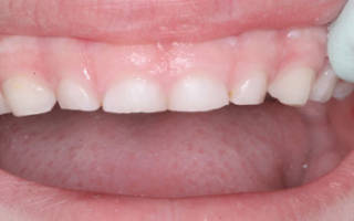 Стертые молочные зубы