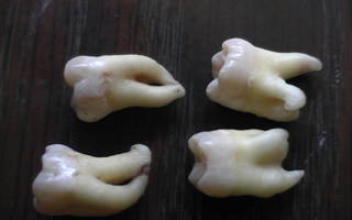 Вырванные зубы с разными корнями
