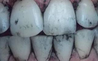 Черные зубы после активированного угля